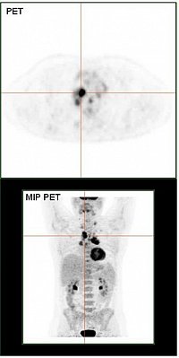 PET Scan (Quelle: https://commons.wikimedia.org/wiki/File:HodgkinLymphomPETCT.jpg, Modifiziert)